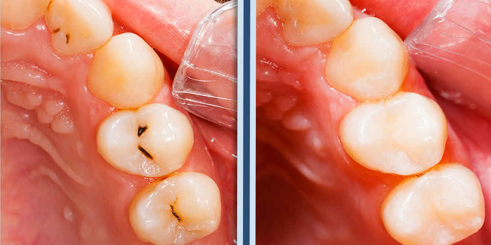 Conservativa_Apertura 1000x500 Conservativa Otturazione Prima e dopo Studio Bianconi dentista Bolzano