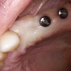 Implantologia_Tecniche_Flapless_300x300