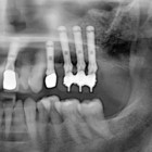 Implantologia_Tecniche_RialzoSeno_300x300