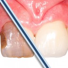 Odonto_Estetica_Corone 300x300