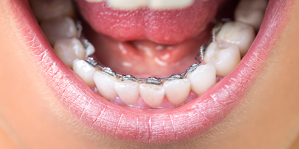 Ortodonzia Apparecchio linguale invisibile Studio Bianconi dentista Bolzano