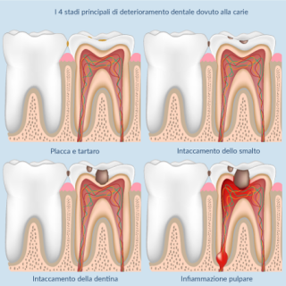 Stadi carie deterioramento intaccamento smalto dentina infiammazione pulpare Studio Bianconi dentista Bolzano