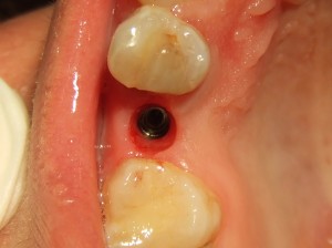 Flapless Technik Implantat Implantologie Studio Bianconi Zahnarzt Bolzano