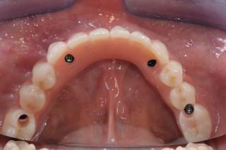 Implantologie Implantat Sofortbelastung All-on-4 Prothese Studio Bianconi Zahnarzt Bozen