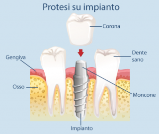 Protesi su impianto osteointegrazione carico immediato corona ponte arcata intera all on 4 overdenture Studio Bianconi dentista Bolzano
