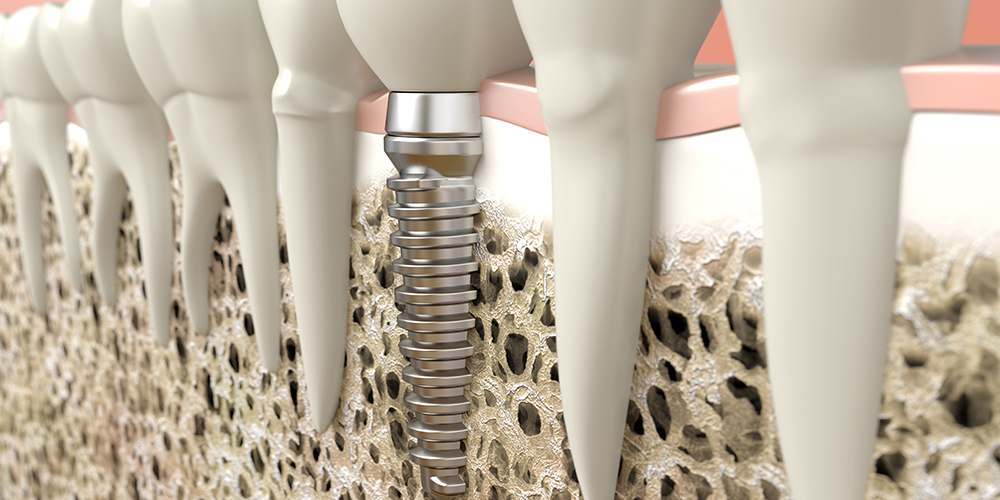 Implantologia_Tecniche_Apertura 1000x500 Implantologia Osteointegrazione Impianto dentale in osso Studio Bianconi dentista Bolzano