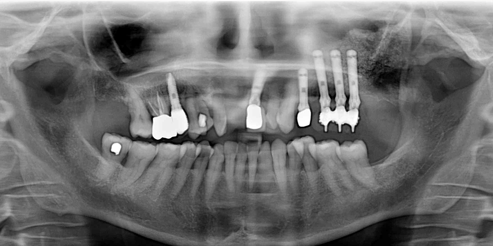 Implantologia_Tecniche_RialzoSeno 1000x500 Implantologia Rialzo del seno mascellare per via crestale o laterale Grande piccolo rialzo Studio Bianconi dentista Bolzano