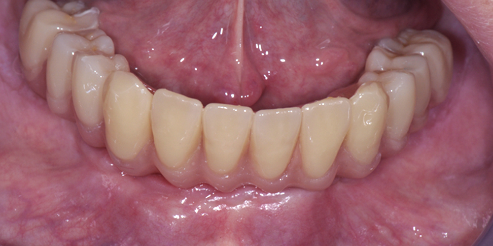 Protesica Denti su impianto Arcata completa All on 4 Studio Bianconi dentista Bolzano