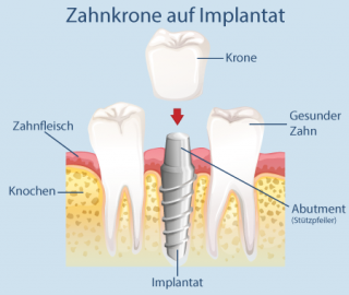 Zahnärztliche Prothetik Implantat Prothese Zahnkrone Zahnbrücke Zahnbogen All-on-4 Overdenture Abutment Studio Bianconi Zahnarzt Bozen