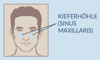 Sinuslift Sinusbodenelevation Augmentation Direkter Transkrestaler Knochentransplantation Studio Bianconi Zahnarzt Bolzano