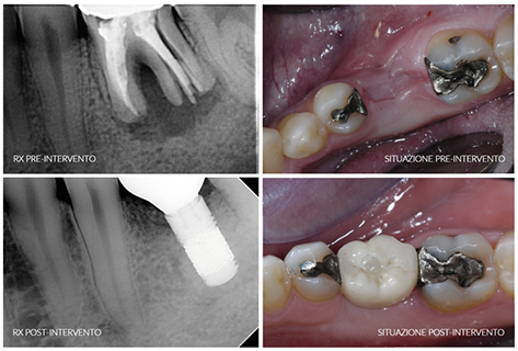 prepostintervento_bianconi_trisi_resized