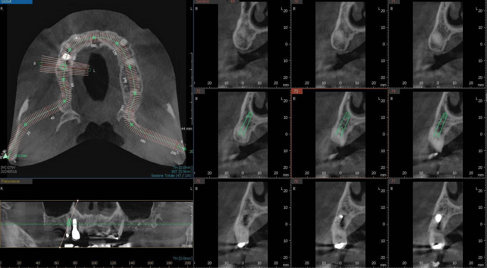 Implantologia-computer-guidata_3