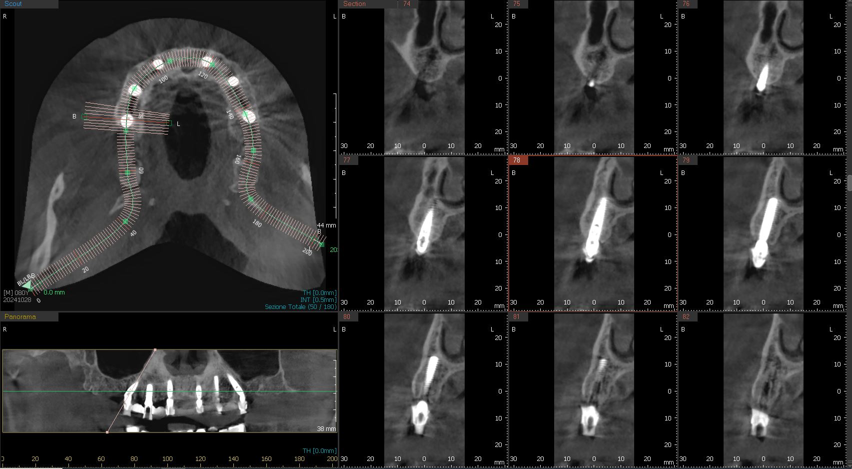 Implantologia-computer-guidata_4